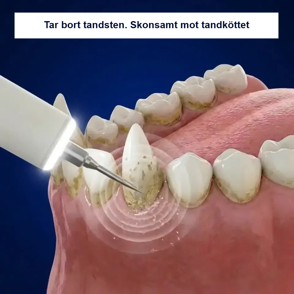 Ultraljudsrengöring tar bort tandsten och är skonsam mot tandköttet
